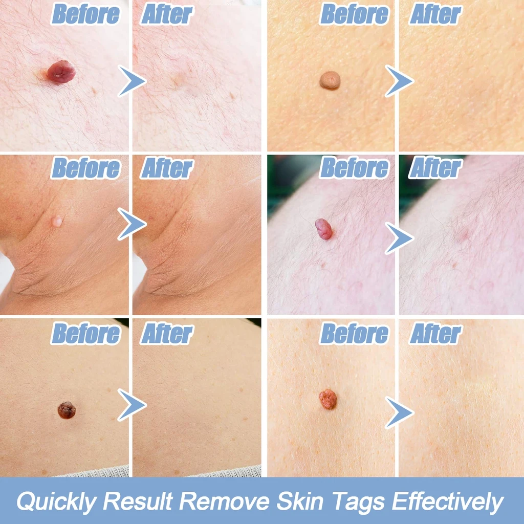 kf-H5f1229fe099b4cc7a13a448e664f26dbJ-Skin-Tag-Kill-Skin-Mole-Wart-Remover-Micro-Skin-Tag-Removal-Kit-With-Cleansing-Swabs-Adult