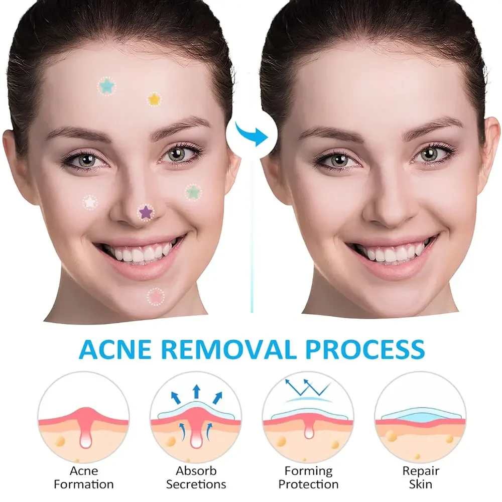 kf-S0195207593fe4e23ac2f6a704ada2501z-40Pcs-Colorful-Cute-Star-Shaped-Acne-Treatment-Sticker-Invisible-Acne-Cover-Removal-Pimple-Patch-Skin-Care